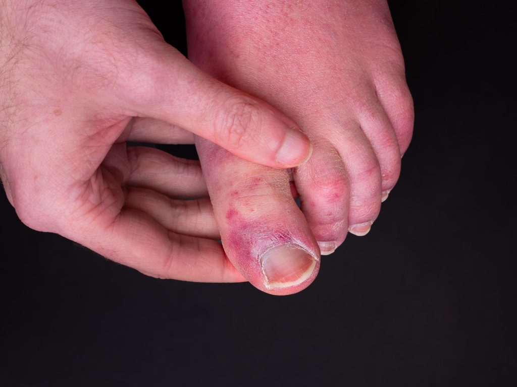 Des éruptions sur les mains et les pieds, un symptôme de Covid-19 ?