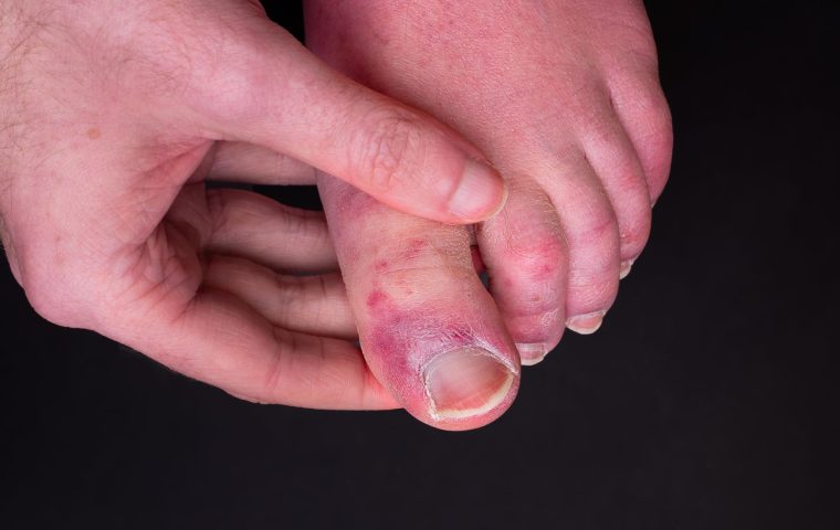 Des éruptions sur les mains et les pieds, un symptôme de Covid-19 ?